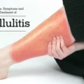 Cellulitis disease