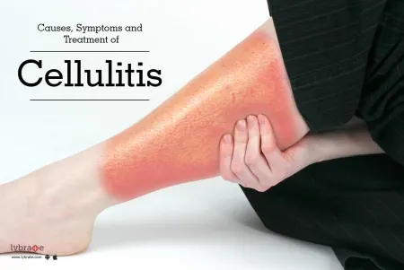 Cellulitis disease: What Is It and How To Get Rid Of It