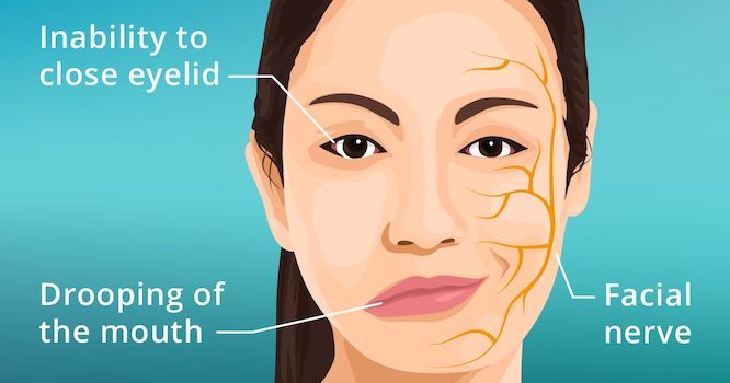 What Is Bell’s Palsy, And What Are The Symptoms?