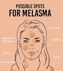 Melasma: What Is It, How Does It Affect People