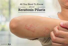 An overview Keratosis pilaris