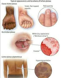 Lichen planus;What Is It and How To Get Rid Of It