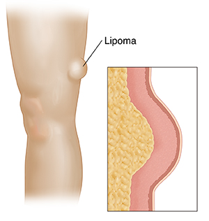 Lipoma: What It Is, How To Treat Them, And What You Need To Know