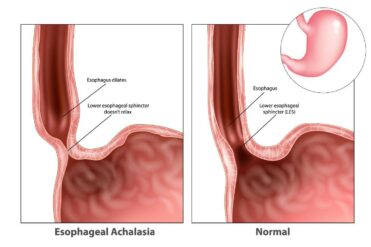 What to Know About treatments for achalasia