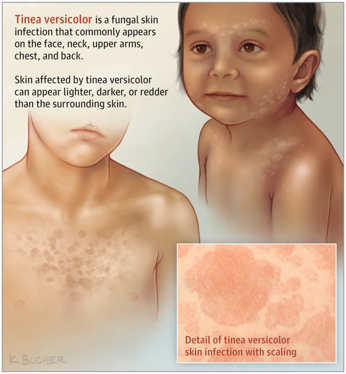 Tinea versicolor: What It Is, How To Diagnose And Treat It