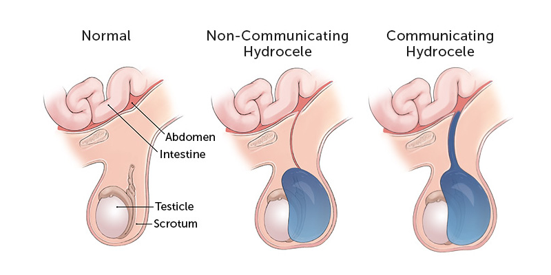 The Causes, Symptoms, And Treatment For icd 10 code for Hydrocele