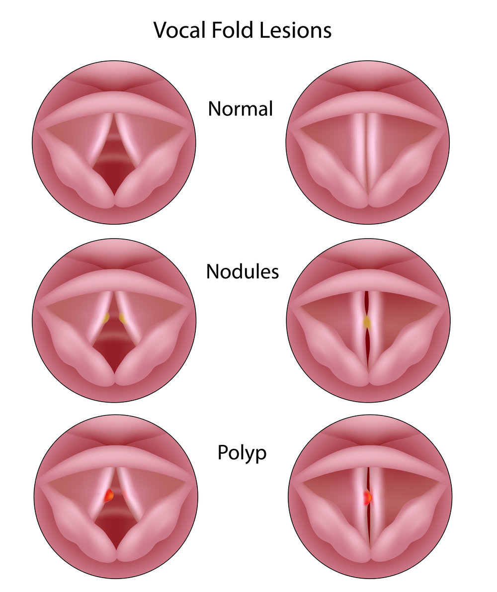 Vocal Cord Nodules: What They Are, How Voice Reveals Internal Health