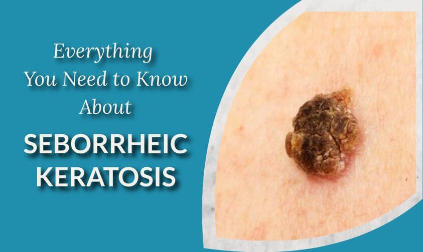 Seborrheic Keratosis: What It Is, What To Do About It