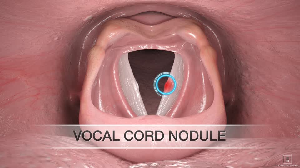 Vocal Cord Nodules: What They Are ?