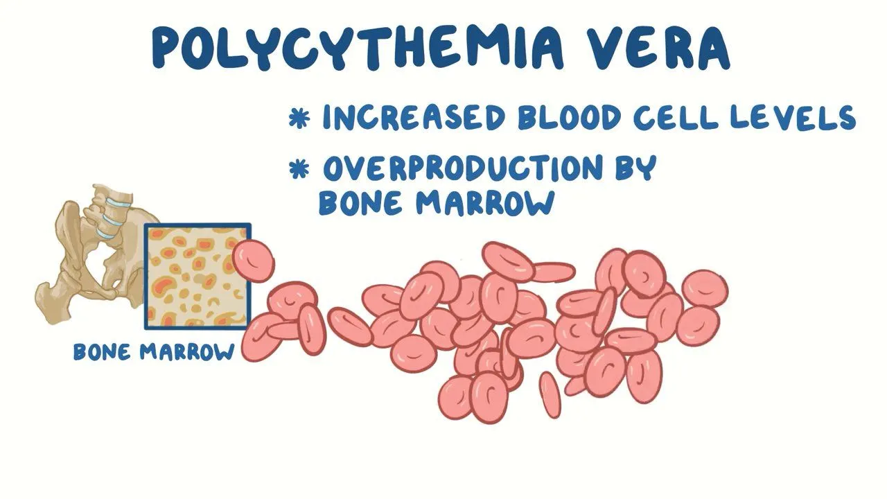 New Treatments For Polycythemia Vera: Causes, Symptoms And Treatment